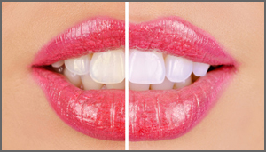 Teeth Whitening in Richardson Texas